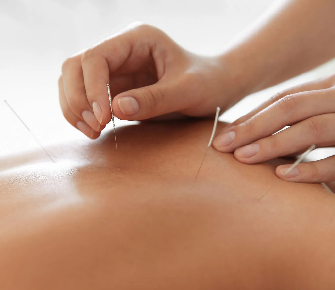 Hands placing acupuncture needles into a patient's back during treatment
